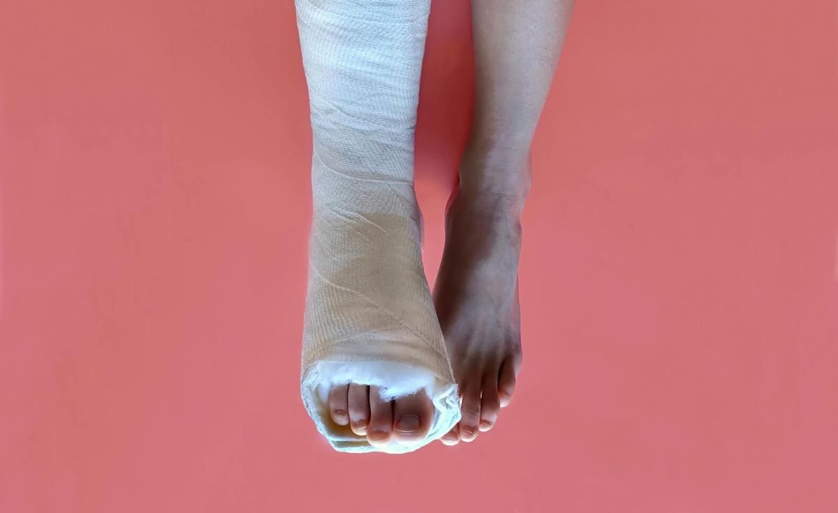 Volare con il gesso: si può? Regole, rischi e consigli pratici