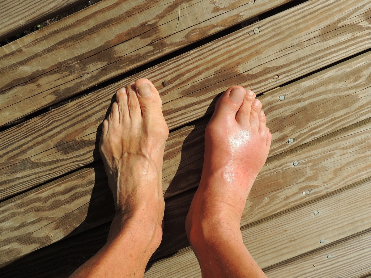 Why Do Passengers get Swollen Feet or Puffy Ankles After Flying, and What to do About It